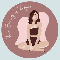 Young woman with Vitiligo sitting. Your beauty is unique. World Vitiligo Day 25th June.