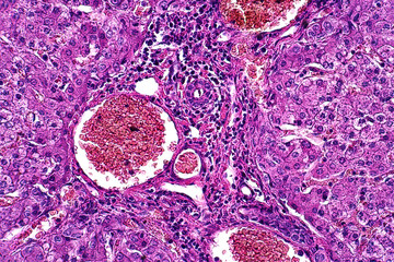 Light microscope of Parenchymatous and fatty degeneration of liver pathology. - obrazy, fototapety, plakaty