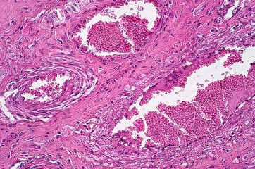 Light microscope of Necrotic oesophagitis pathology.