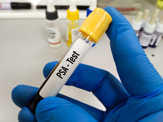 Blood sample tube for total PSA, PSA test at medical laboratory.
