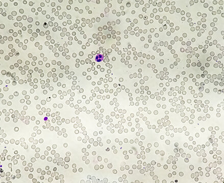 Acute leucopenia and thrombocytopenia. close up micrograph
