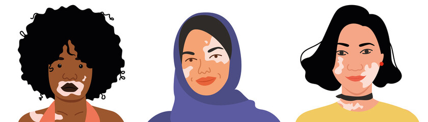 A set of women with Vitiligo of different nationalities and appearances. Flat vector illustration. Skin disease, body positive, self-acceptance, beauty.