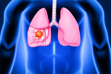 Medical Illustration showing lung cancer or bronchial carcinoma on scientific background. 3d illustration