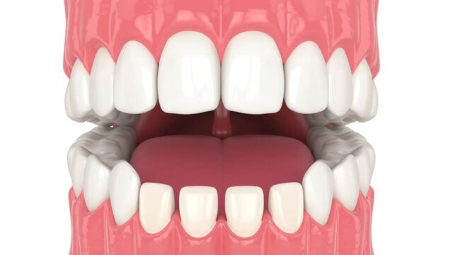 Human jaw with dental veneers installation