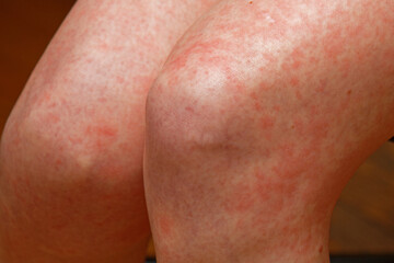 Red skin rash medical condition