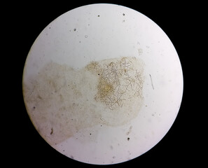 Microscopic view of dermatophytes, skin scraping for fungus test