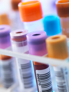 A row of human blood samples awaiting testing in the lab