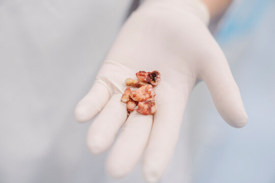 Extracted teeth in dentist's hand