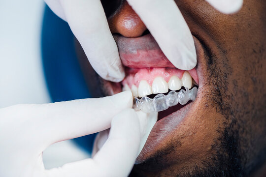 Close-up of dentist applying aligner to patient's teeth