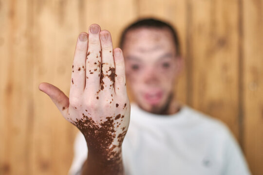 Young man with vitiligo