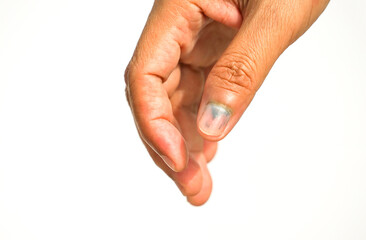 old woman hand bleeding, bruising under a thumb nail that hurt by pressure from door,car...