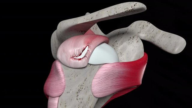 Shoulder Surgery With Corner Stitch Suture for the Rotator Cuff Tear