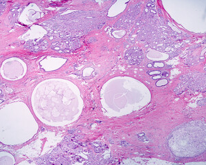 Fibrocystic breast disease