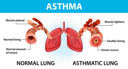 Bronchial Asthma diagram with normal lung and asthmatic lung - obrazy, fototapety, plakaty