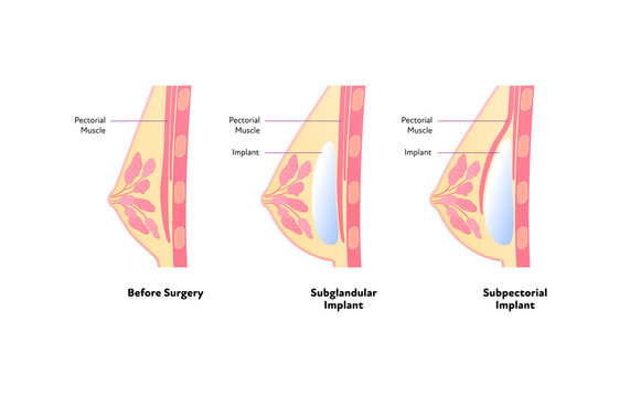 Female breast surgery infographic chart. Vector flat medical illustration. Set of human breast before and after with different implant on white background. Subglandular and subpectorial type.