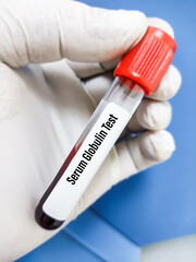 Blood sample for Serum Globulin test, diagnosis of liver disease.