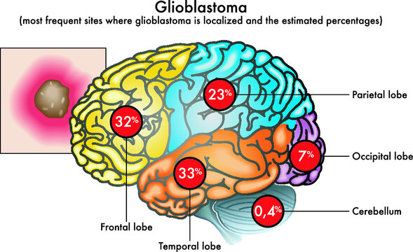 Medical illustration of most frequent sites where glioblastoma is localized in the brain and the estimated percentages.