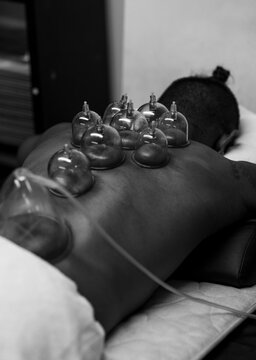Cupping 