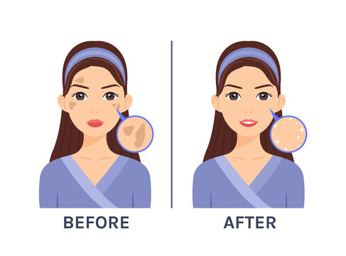 Cartoon Beautiful Woman with Pigmented Spots on Face. Problem Skin. Skin Disease. Treatment. Before After. Happy Young Girl with a Clean Health Face. Illustration for Beauty and Medical Design. Vector