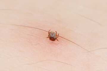 Sucking tick Macro photo on human skin. Ixodes ricinus. Bloated parasite bitten into pink irritated epidermis. Dangerous insect mite. Encephalitis, Erythema that may show Lyme disease infection.