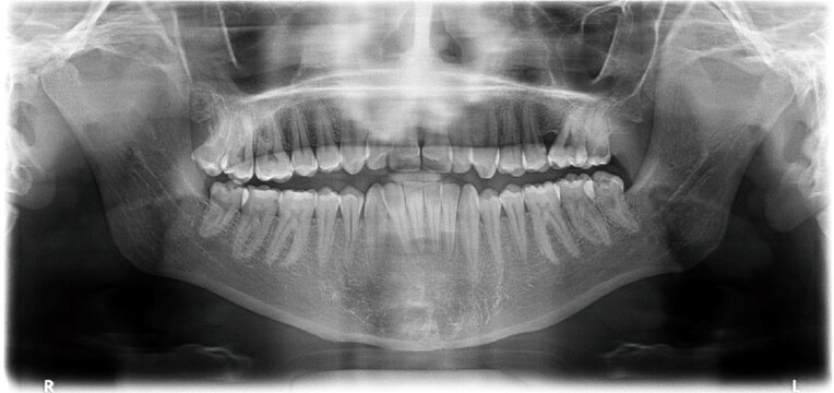 Panoramic x-ray image of teeth.