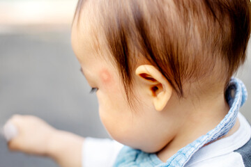 0才の男の子の横顔　蚊に刺されて赤くなっている