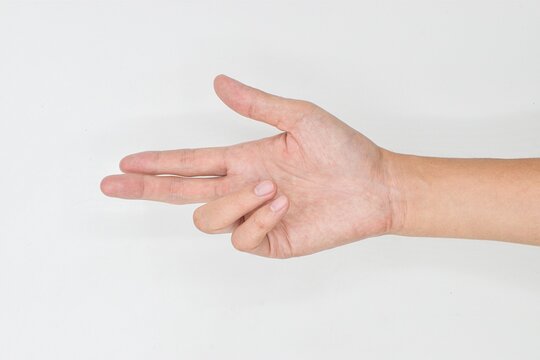 Unilateral Dupuytren’s contracture in Asian young man. Unilateral hand abnormality.