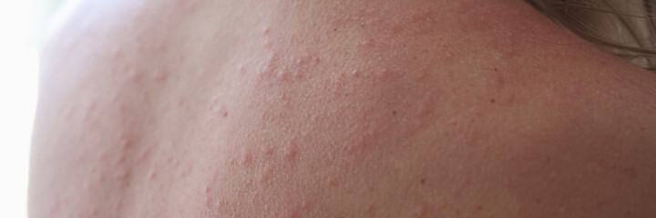 Fototapeta premium Woman injured back with rash and red sun spots