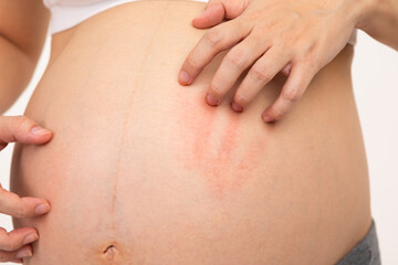 Close up Pregnant woman scratching her big belly itchy skin.Unrecognizable pregnancy woman having a skin problem on belly and scratching on itchy spot.Pregnancy Care Concept - obrazy, fototapety, plakaty