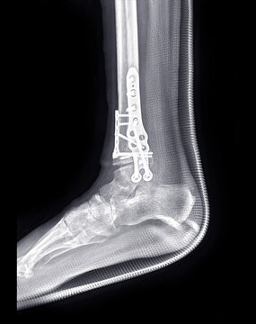  X-ray image of ankle joint showing surgical treatment by internal fixation with plate and screw.