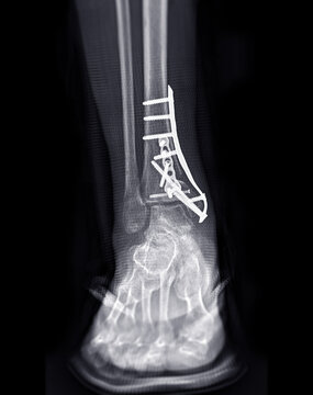  X-ray image of ankle joint showing surgical treatment by internal fixation with plate and screw.