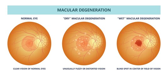 macular degeneration hemorrhage dry wet Age hole pucker edema eye vision loss AMD retina drusen blind spots Blood vessels leak blurry adult lose visual field exam treat contact lens myopia older tear