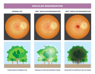 macular degeneration hemorrhage dry wet Age hole pucker edema eye vision loss AMD retina drusen blind spots Blood vessels leak blurry adult lose visual field exam treat contact lens myopia older tear