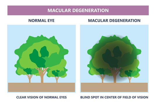 Macular Degeneration Hemorrhage Dry Wet Age Hole Pucker Edema Eye Vision Loss AMD Retina Drusen Blind Spots Blood Vessels Leak Blurry Adult Lose Visual Field Exam Treat Contact Lens Myopia Older Tear