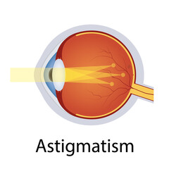 Astigmatism and Vision Disorders Illustration. Eyes Defect Concept. Detailed Anatomy Eyeball with Astigmatism Defect. Isolated Vector