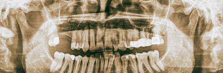 Panoramic dental x-ray of woman