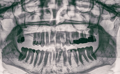 X ray view of woman denture