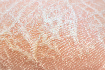 Fototapeta premium Close-up photo with dry skin on the heel of the feet