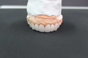 Fototapeta na wymiar A dental bridge made of zirconia material that is made by a technician for the dentist to put on the patient.