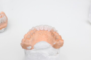 A dental  bridge made of zirconia material that is made by a technician for the dentist to put on the patient.