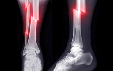 X-ray image of ankle joint showing fracture tibia and fibula bone.' - obrazy, fototapety, plakaty