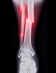 X-ray image of ankle joint showing fracture tibia and fibula bone.'
