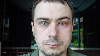 Portrait of Man with Swollen Eye, Suffers from Conjunctivitis. Male Disease with Severe Bloodshot...
