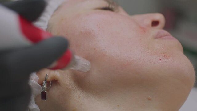 Close-up of a woman face. Needle mesotherapy procedure into the skin of the face