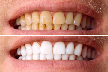 Teeth before and after whitening. Over white background. Dental clinic patient. Image symbolizes oral care dentistry, stomatology.