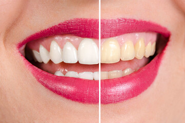 Before and after teeth whitening, closeup shot. Left half of image of beautiful white teeth and...
