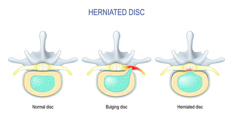 Difference Between Bulging disc and Herniated Disc.