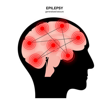epilepsy seizure concept