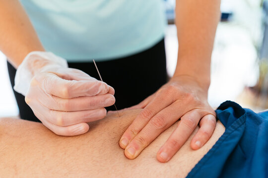 Acupuncture treatment of patient