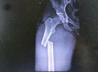 X-Ray of broken Femur Bone